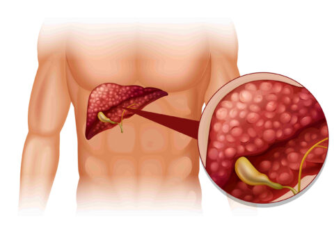 Fatty Liver Disease