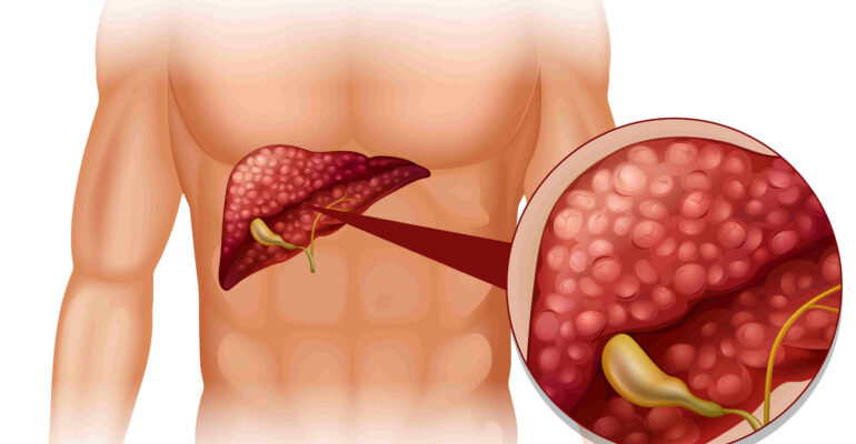 Fatty Liver Disease