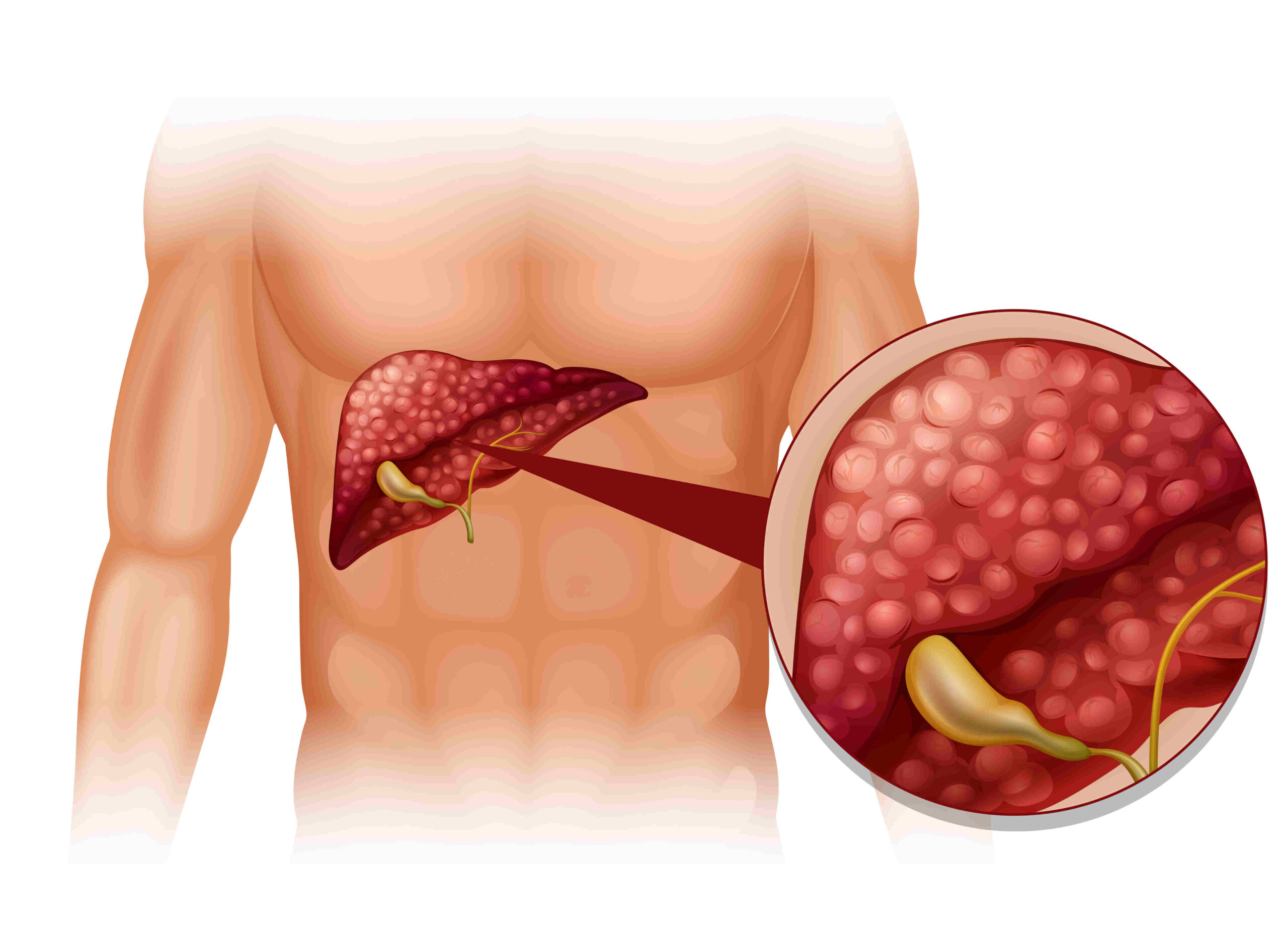 Fatty Liver Disease